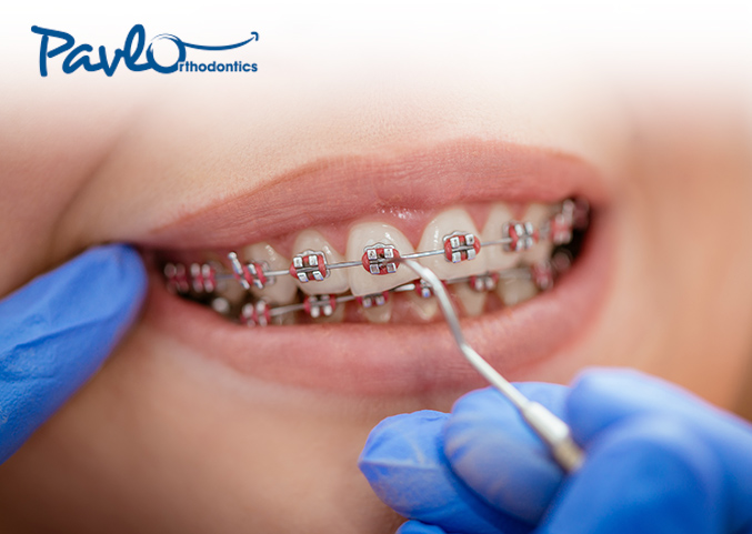 Orthodontic emergencies have easy solutions.
