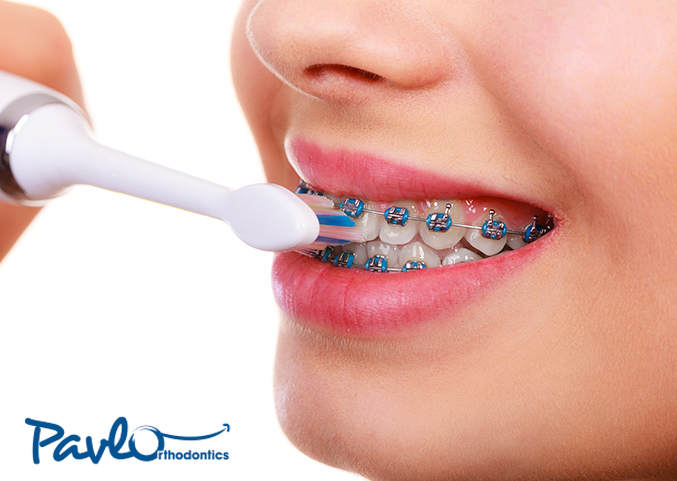Dental hygiene is critical for orthodontics. Make sure you pay close attention to it.