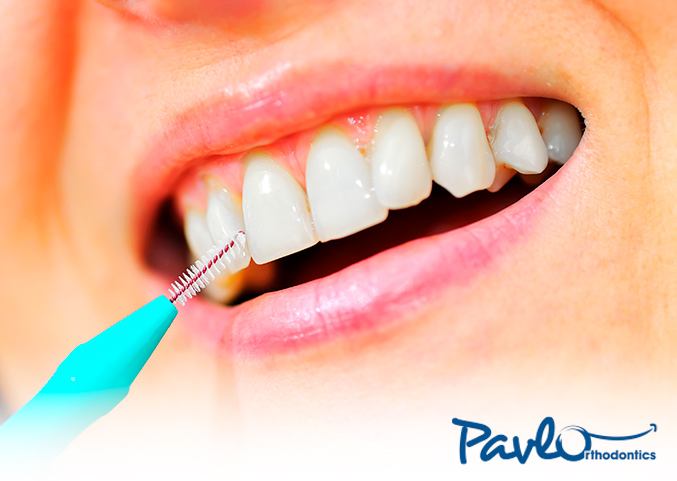Using an interdental brush can help you maintain good oral hygiene during orthodontics.
